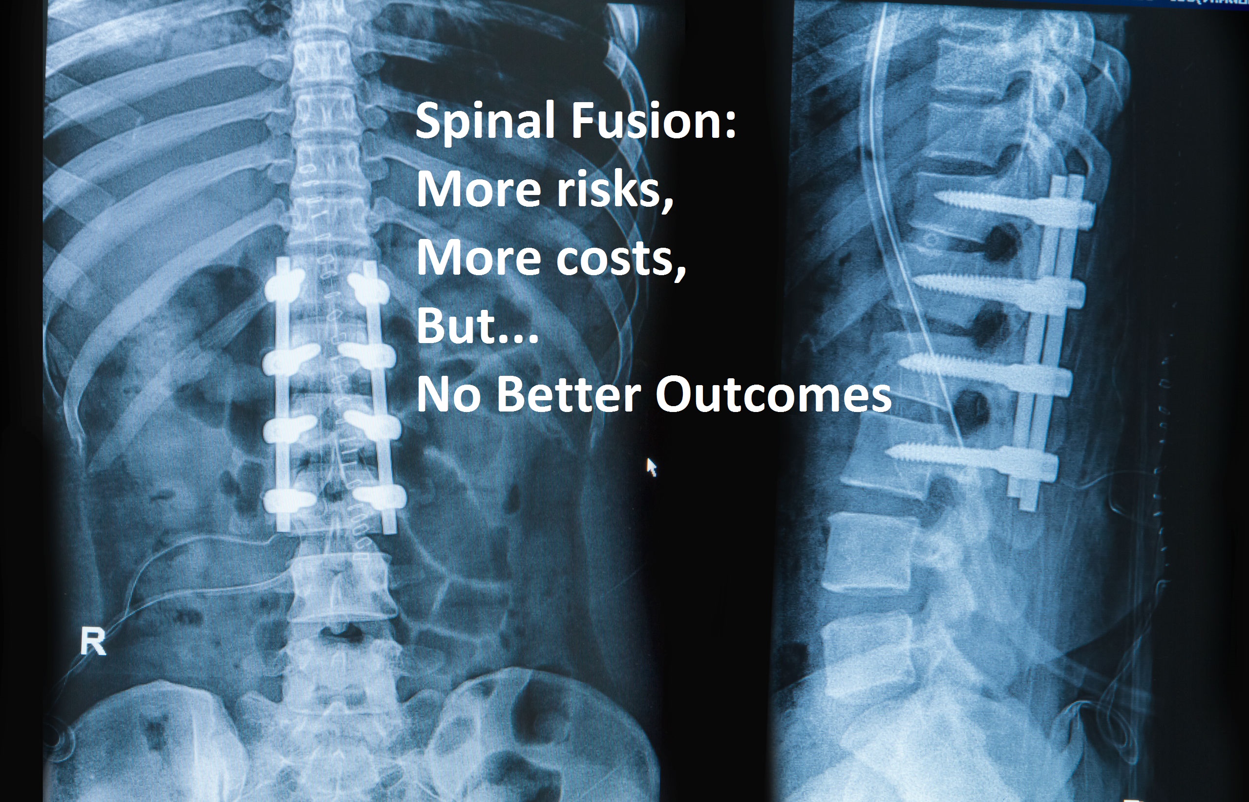 Spinal Fusions: Necessary Treatment? - Regenerative Orthopedic Institute